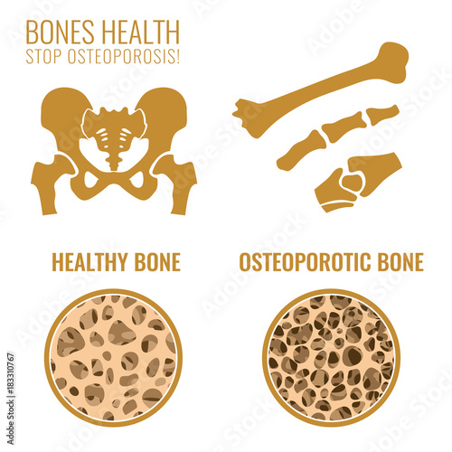 Osteoporosis Stages Image