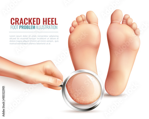 Cracked Heels Illustration