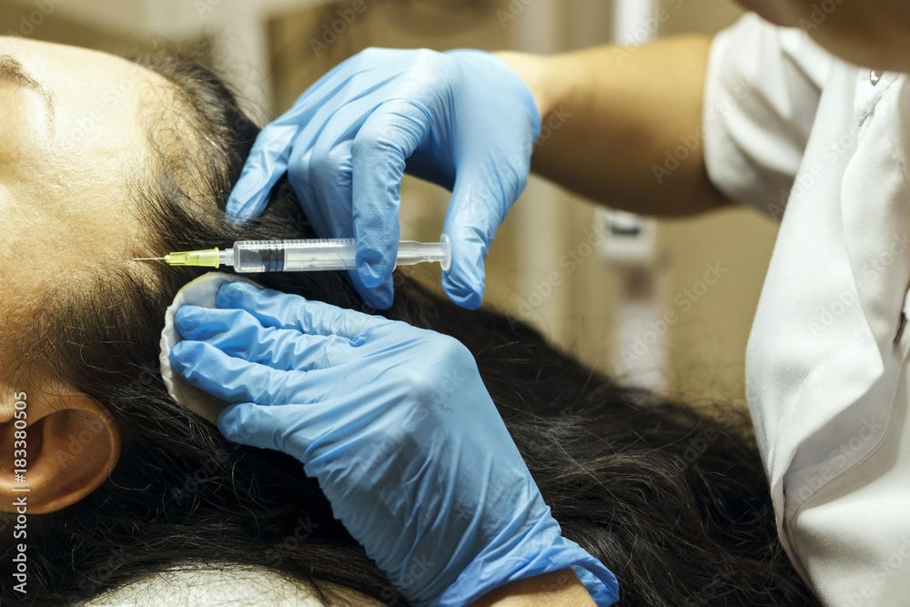 The procedure for treating hair from falling out by injection. The