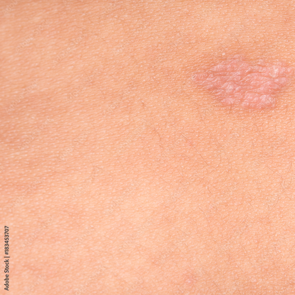 Psoriasis skin. Psoriasis skin.