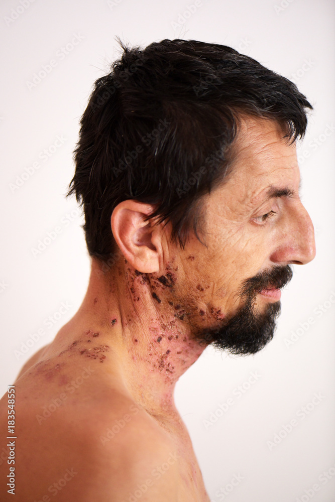 Obraz premium Herpes zoster