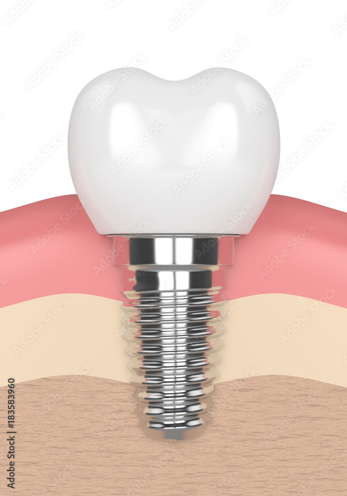 3d render of dental implant in gums 3d render of dental implant in gums