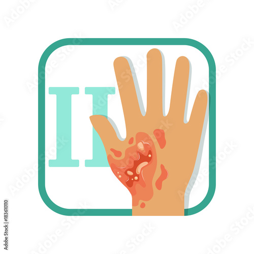 Training card showing second degree burn. Redness with clear blister on hand. Flat vector design for illustration teaching book, poster or flyer