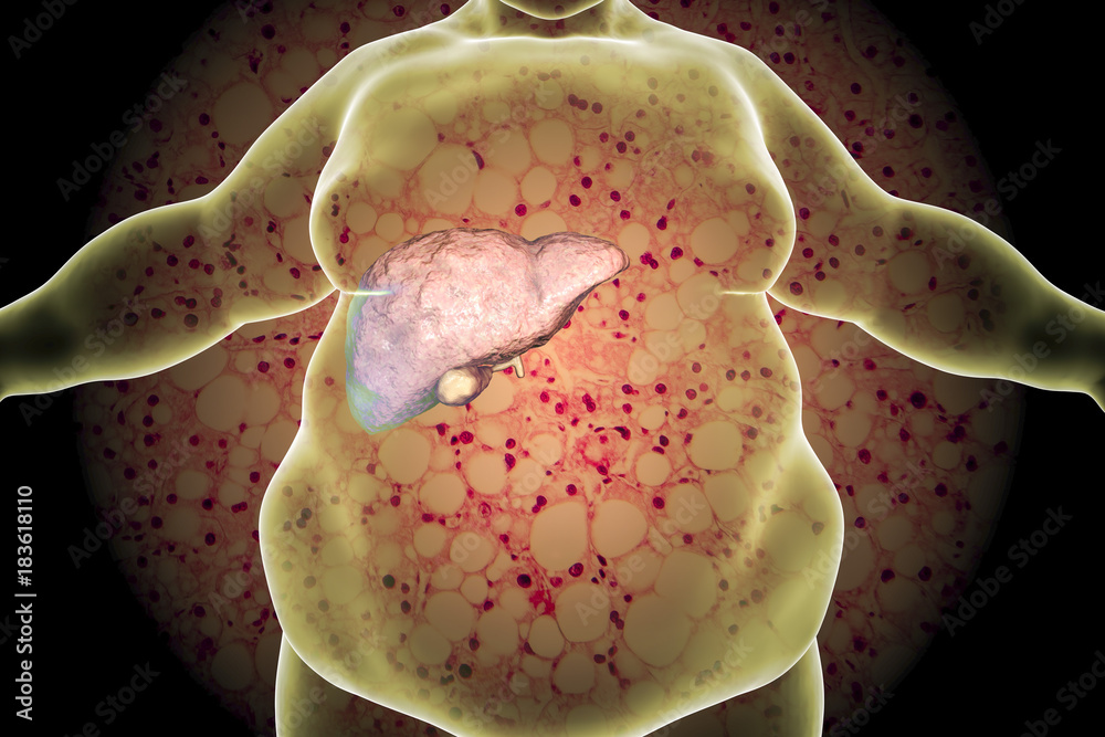 Obese man with fatty liver on background with micrograph of liver steatosis, 3D illustration. Conceptual image for non-alcoholic fatty liver disease - obrazy, fototapety, plakaty 