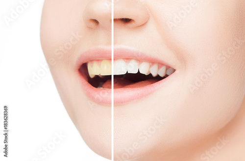 The female teeth before and after whitening.