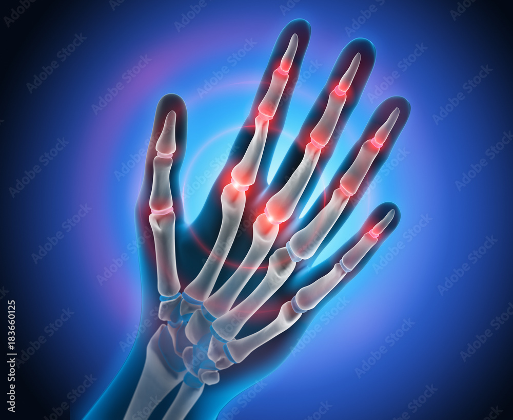 Naklejka premium Arthritis in Fingergelenken 2