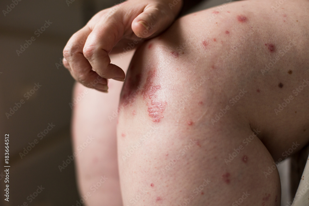 The problem with many people - eczema or psoriasis on hand skin. Woman itchind dry skin on legs. Ill allergic rash The problem with many people - eczema or psoriasis on hand skin. Woman itchind dry skin on legs. Ill allergic rash