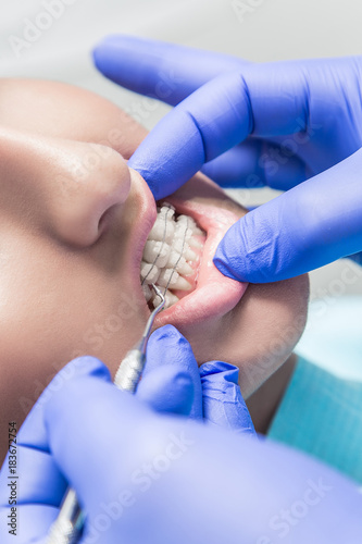 улыбка девушки с брекетами, а рука врача лечит зубы