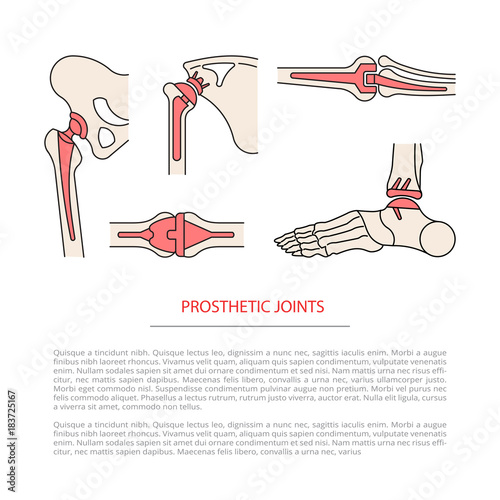implantation joint skeleton