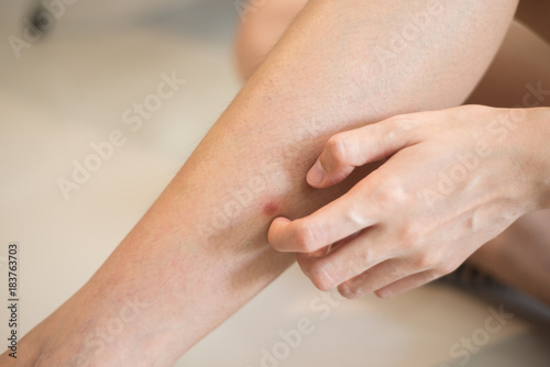 Woman hand scratching on leg, Concept with Healthcare And Medicine.