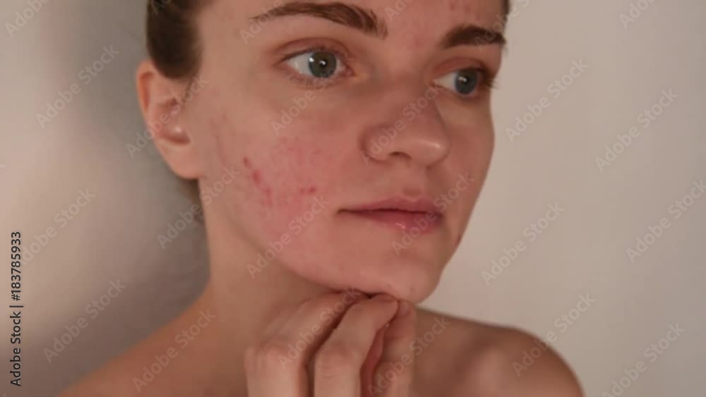 Beautiful young brunette girl crushes white and red pimples and acne on her face on a white background Beautiful young brunette girl crushes white and red pimples and acne on her face on a white background