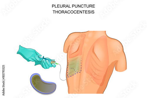 thoracocentesis,  pleural puncture photo
