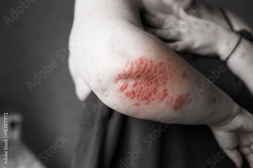 Pain red spot on woman hand with eczema rash or allergy. Conceptual photo about healtcare and skin problems. Atopic psoriasis close up skin. photo
