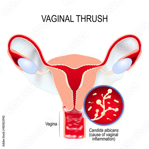 Vaginal yeast infection and Candida albicans