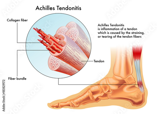 symptoms of  achilles tendonitis