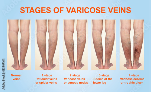 Varicose veins on a female senior leg