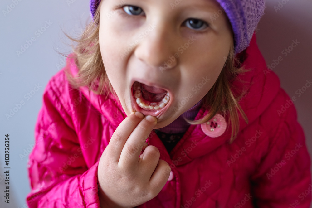 Adult permanent teeth coming in behind baby teeth: shark teeth. Adult permanent teeth coming in behind baby teeth: shark teeth.