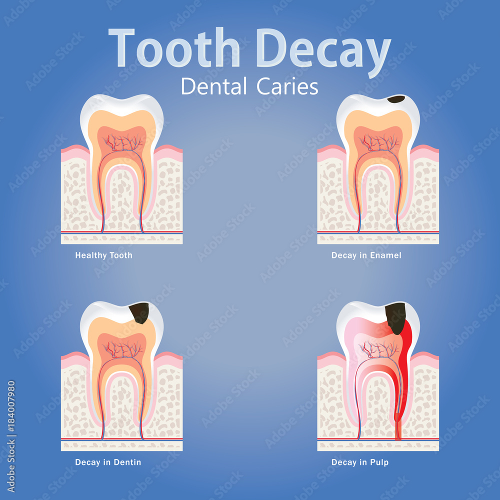 Stages of tooth decay, Dental Caries anatomy concept with healthy tooth ...