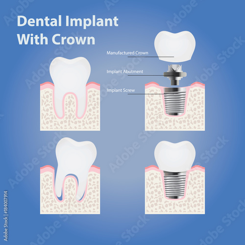 Dental implant with crown and healthy tooth. anatomy
