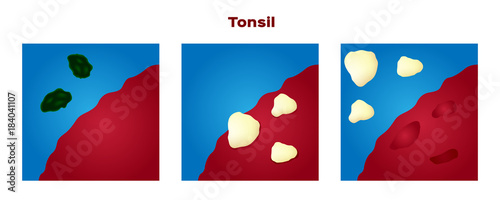 tonsil stone in the mouth vector
