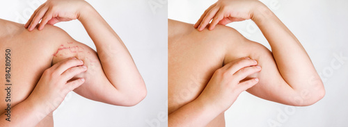 body striae, stria on the arm  before and after surgery and procedure photo
