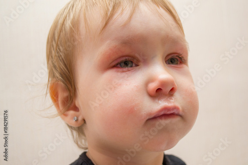 portrait of a child of a girl 1 or 2 years old with a runny nose and red eyes due to an influenza virus or conjunctivitis