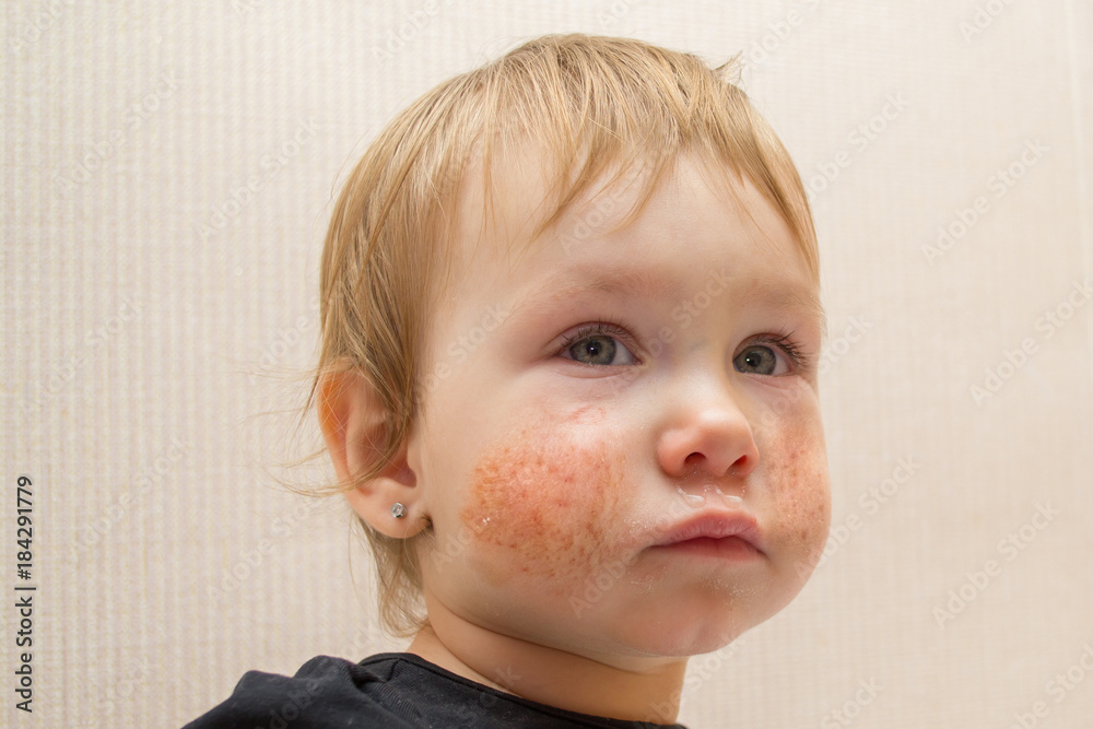 Cute child 1 2 years old with eczema or allergic rash on his face