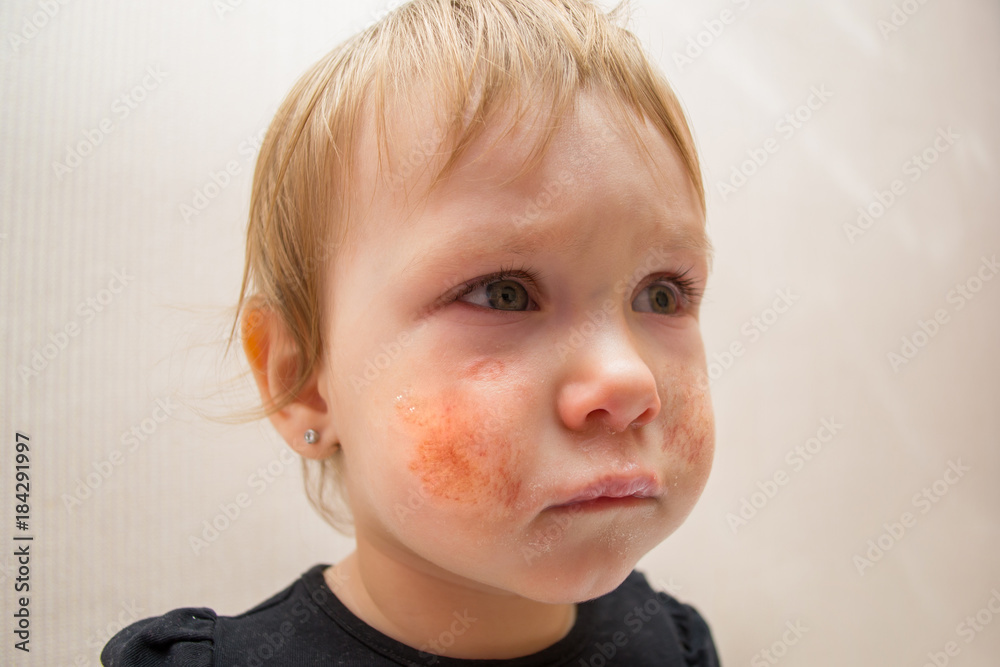 Cute child 1 2 years old with eczema or allergic rash on his face