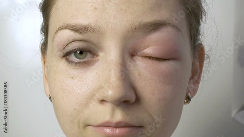 Young smiling woman with allergy on eye
