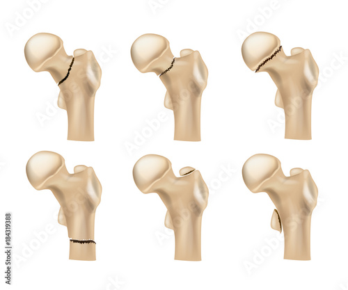 Hip Fractures. Basic fracture types.