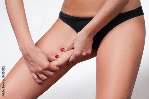  Woman grabbing skin on her leg. Cellulite fat removal skin.