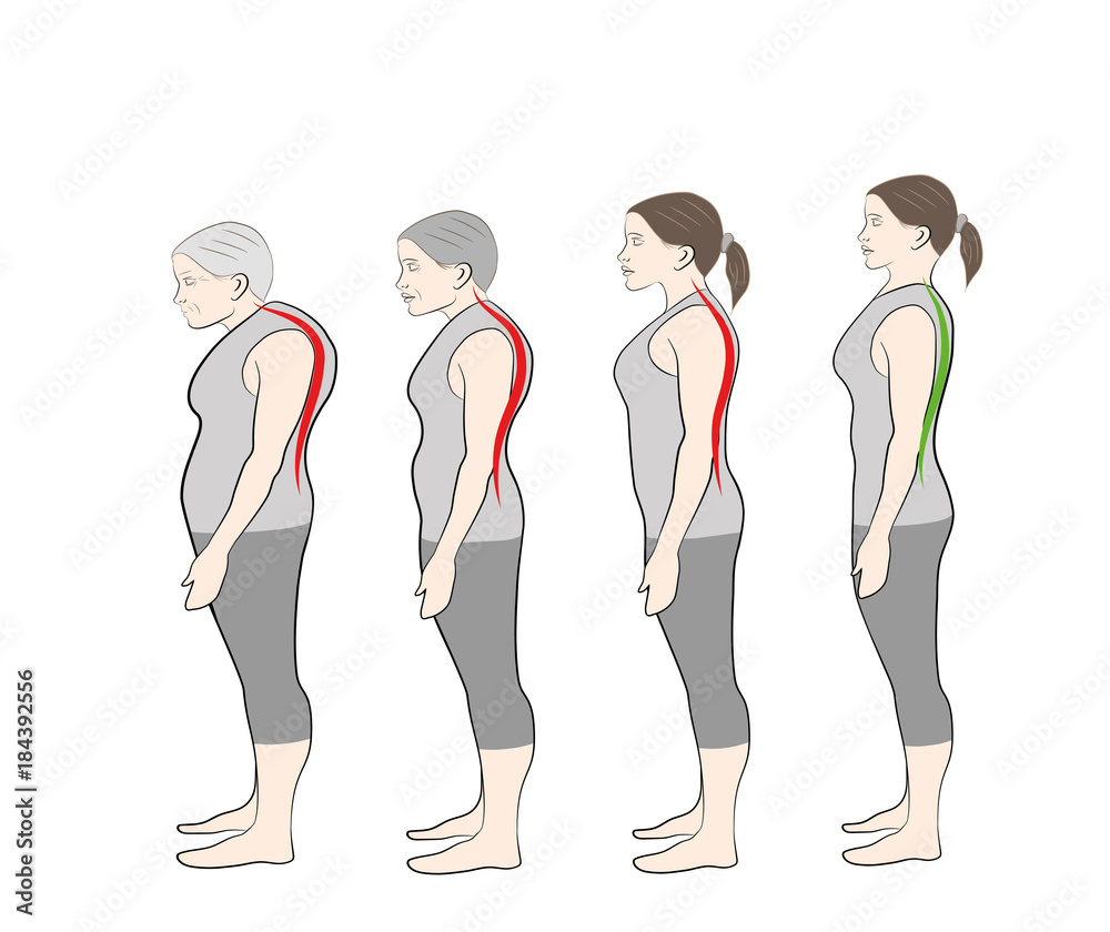 Fototapeta premium Development of a stooped stance with age, showing increasing curvature of the spine