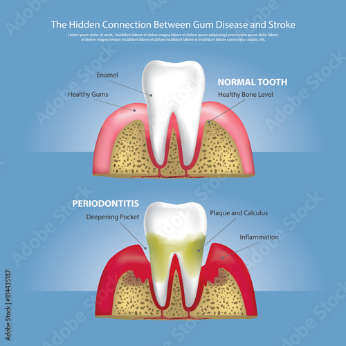 Hidden Connection Between Gum Disease and Stroke Vector Illustration