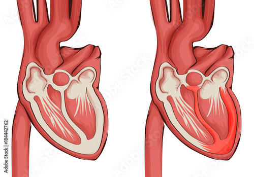 Vector illustration of heart healthy and diseased myocarditis photo