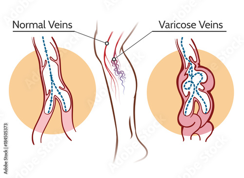 Varicose veins. Healthy leg vascular system and vessels thrombosis vector illustration