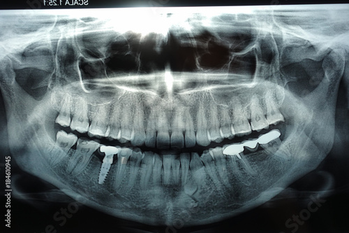 panoramic dental x ray with implant