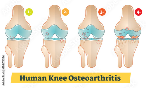 Human Knee Osteoarthritis vector diagram illustration