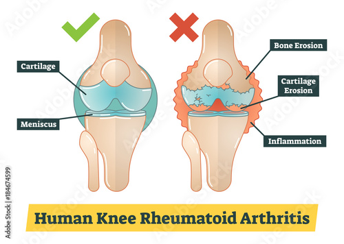 Human Knee Rheumatoid Arthritis vector diagram illustration photo