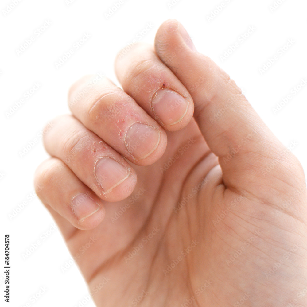 Bitten fingers close-up on a white background. Terribly badly bitten fingers of a hand. Stress. Nervousness. Habit. Depression. Till blood. Mutilated. Isolate Bitten fingers close-up on a white background. Terribly badly bitten fingers of a hand. Stress. Nervousness. Habit. Depression. Till blood. Mutilated. Isolate