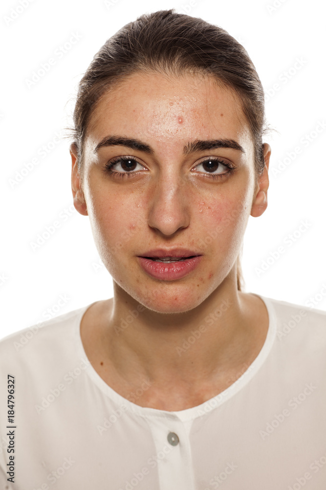 a young woman with a problematic skin on her face a young woman with a problematic skin on her face