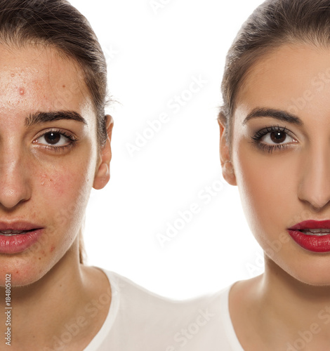 Comparision of before anf after mkeup on young woman with a problematic skin on her face photo