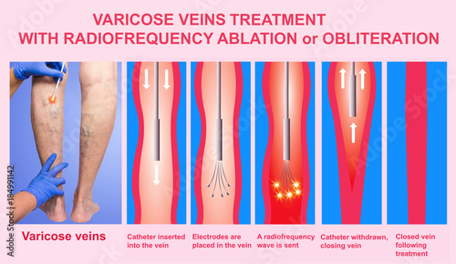 фотографія Varicose Veins and Treatment with radiofrequency ablation