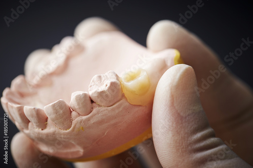 Dental plaster model