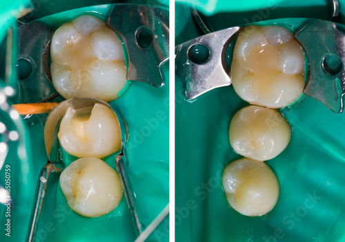 Fototapeta Naklejka Na Ścianę i Meble -  Dental filling comparison, before - after