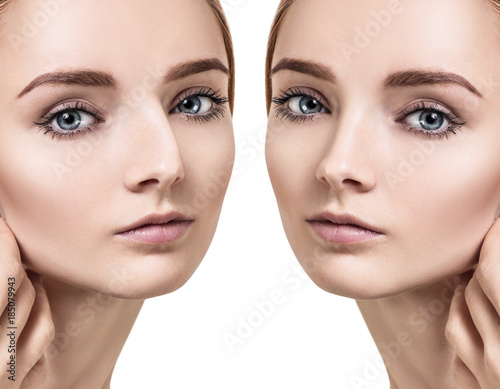 Female nose before and after cosmetic surgery.