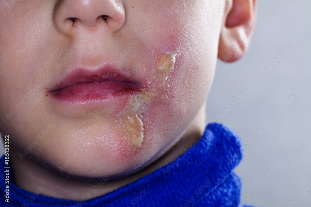 Blisters On Chin