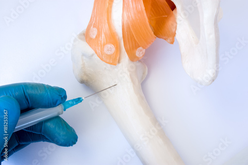 Bone marrow examination procedure: biopsy, aspiration or paracentesis concept photo. Doctor holds in hand dressed in glove syringe needle and puncture model of hip bone to take analysis of bone marrow photo