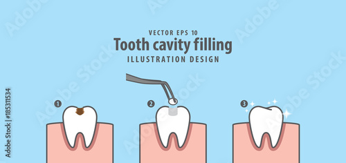 Step of tooth cavity filling illustration vector on blue background. Dental concept. photo