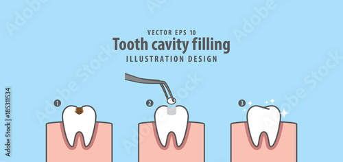 Step of tooth cavity filling illustration vector on blue background. Dental concept.