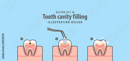 Step of tooth cavity filling cross-section structure inside tooth illustration vector on blue background. Dental concept. photo